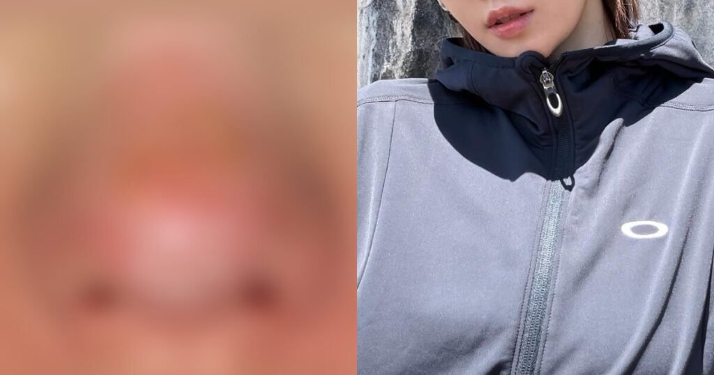 Gorgeous K-Pop Idol Reveals Shocking Second-Degree Facial Burns