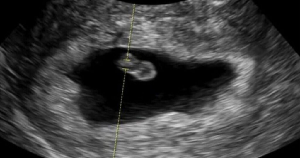 Actor-Idol Couple Announces Pregnancy Following Previous Miscarriage Actor-Idol Couple Announces Pregnancy Following Previous Miscarriage