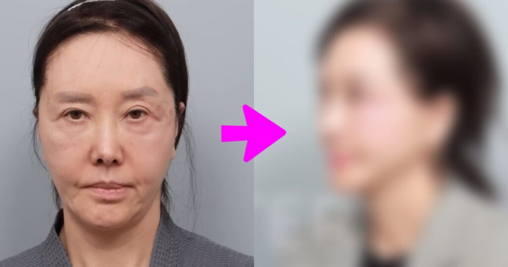 61-Year-Old Actress Shocks With New Face After Cosmetic Procedures