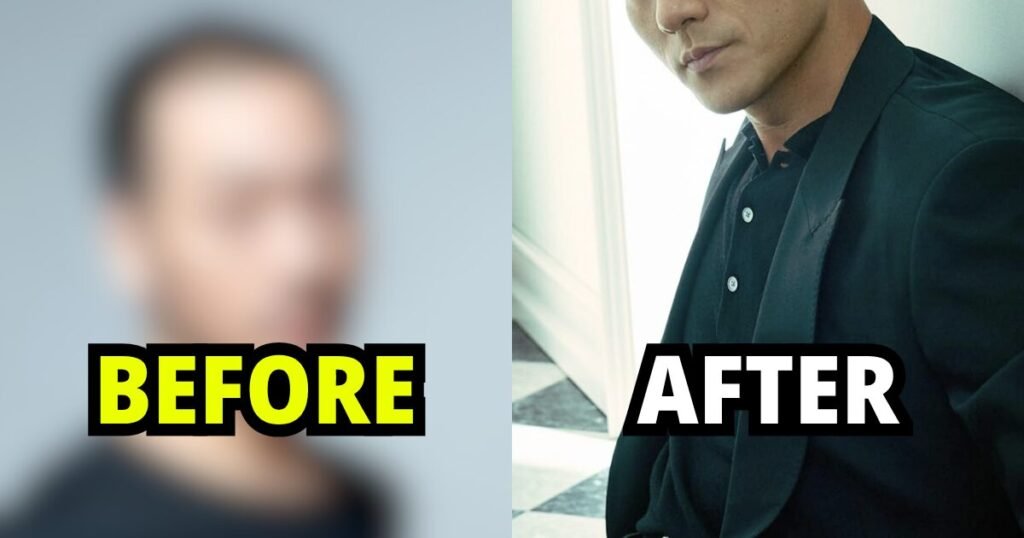 Popular Actor's Alleged Hair Transplant Leaves Him Unrecognizable