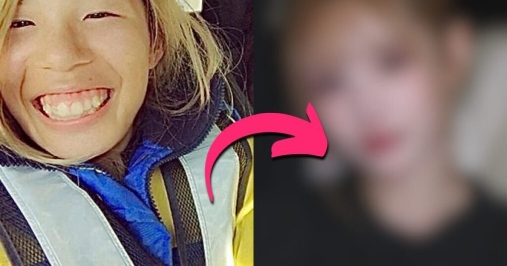 Woman Spends A Fortune On 25 Plastic Surgeries To Turn Into A Model Face