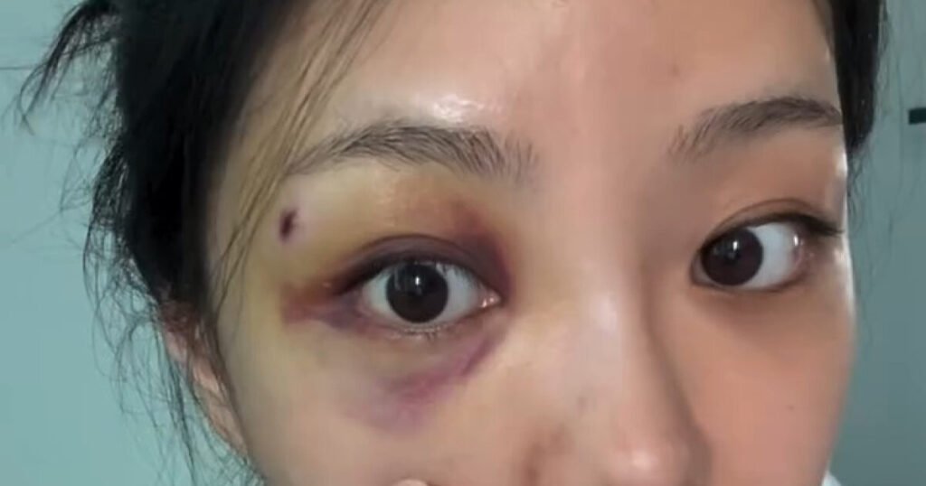 Reality Dating Show Star Addresses Rumors Surrounding Her Heavily Bruised Eye
